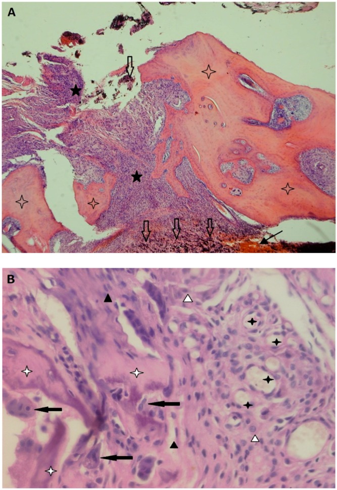 Periprosthetic Osteolysis: Mechanisms, Prevention and Treatment - PMC