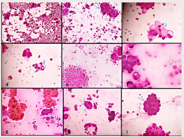 
Figure 1. a) cytologic smear characterized by abundant neoplastic cells in a
mesothelioma (HEx250), b) papillary cell groups with scalloped borders in an
adenocarcinoma (arrow) (HEx250), c) tumor cell with peripheral vacuoles or blebs
in
RL (arrow) (HEx400), d) intracytoplasmic vacuoles overlapping the nuclei appearing
as “punched out holes” in an adenocarcinoma (arrow) (HEx400), e) intercellular
clear
spaces or «windows» within the clusters (arrows) in a mesothelioma (HEx250), f)
«cell in cell» engulfment of mesothelial cells (arrow) in a mesothelioma (HEx400),
g)
tumour cell with multinucleation (arrow) in an adenocarcinoma (HEx400), h)
acidophilic
extracellular matrix bodies also known as collagen cores around papillary cell
groups
in a RL (arrow) (HEx250), i) monomorphic aspect of tumor clusters (arrow) in a
mesothelioma (HEx400).
