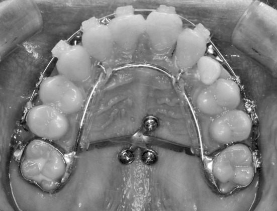 Figure 1. The MPAP placed on the palate of a patient with late mixed dentition.