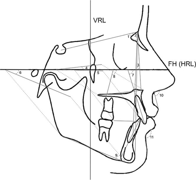 Figure 4. Angular measurements: 1, SNA; 2, SNB; 3, facial angle (FH/N-Pg); 4, palatal plane angle (FH/ANS-PNS); 5, occlusal plane angle (FH/OP); 6, mandibular plane angle (FH/Go-Me); 7, maxillary central incisor inclination; 8, maxillary first molar inclination; 9, incisor mandibular plane angle (IMPA); 10, nasolabial angle; 11, mentolabial fold angle.