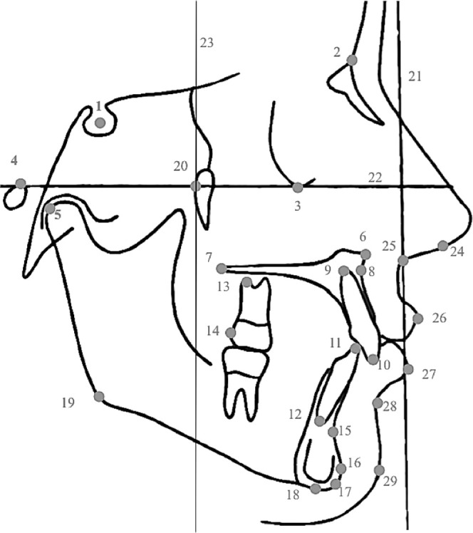 Figure 2. Landmarks and reference lines: 1, sella; 2, nasion; 3, orbitale; 4, porion; 5, condylion; 6, anterior nasal spine (ANS); 7, posterior nasal spine (PNS); 8, a point; 9, maxillary central incisor root apex; 10, maxillary central incisor incisal edge; 11, mandibular central incisor incisal edge; 12, mandibular central incisor root apex; 13, maxillary first molar root apex; 14, maxillary first molar crown; 15, B point; 16, pogonion; 17, gnathion; 18, menton; 19, gonion; 20, pterygoid point; 21, true vertical line; 22, Frankfort horizontal plane; 23, vertical reference line; 24, columella; 25, subnasale; 26,upper lip; 27, lower lip; 28, soft tissue B point; 29, soft tissue pogonion.