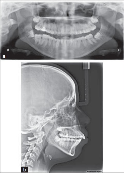 Influence of third molars in Le Fort 1 osteotomy - PMC