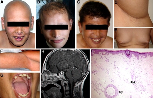 Alopecia, Neurological Defects, And Endocrinopathy Syndrome Caused By 