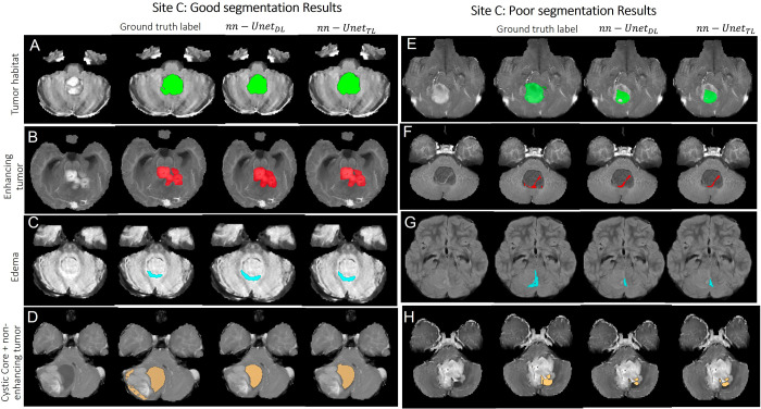 Representative examples of (A–D) good and (E–H) poor segmentation results obtained on patients from site C using both segmentation models. Each row shows, from left to right, the original MRI scan, the reference standard label for the subcompartment of interest, segmentation result from the nnU-NetDL model, and segmentation result from nnU-NetTL. Tumor habitat example segmentation results are shown in A (prediction accuracies of 0.89 for nnU-NetDL and 0.89 for nnU-NetTL) and E (accuracies of 0.51 for nnU-NetDL and 0.53 for nnU-NetTL). Enhancing tumor example segmentation results are shown in B (prediction accuracies of 0.9 for nnU-NetDL and 0.93 for nnU-NetTL) and F (accuracies of 0.49 for nnU-NetDL and 0.51 for nnU-NetTL). Edema example segmentation results are shown in C (prediction accuracies of 0.78 for nnU-NetDL and 0.78 for nnU-NetTL) and G (accuracies of 0.42 for nnU-NetDL and 0.42 for nnU-NetTL). Finally, nonenhancing tumor plus cystic core example segmentation results are shown in D (prediction accuracies of 0.81 for nnU-NetDL and 0.78 for nnU-NetTL) and H (accuracies of 0.48 for nnU-NetDL and 0.51 for nnU-NetTL). nnU-NetDL = direct learning nnU-Net model, nnU-NetTL = transfer learning deep learning model.