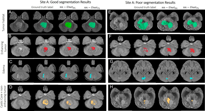 Representative examples of (A–D) good and (E–H) poor segmentation results obtained on patients from site A using both segmentation models. Each row shows, from left to right, the original MRI scan, the reference standard label for the subcompartment of interest, segmentation result from the nnU-NetDL model, and segmentation result from nnU-NetTL. Tumor habitat example segmentation results are shown in A (prediction accuracies of 0.9 for nnU-NetDL and 0.9 for nnU-NetTL) and E (accuracies of 0.54 for nnU-NetDL and 0.53 for nnU-NetTL). The poor results in E are perhaps on account of the subtle differences between enhancing and nonenhancing tumor and the highly heterogeneous tumor case. Enhancing tumor example segmentation results are shown in B (prediction accuracies of 0.73 for nnU-NetDL and 0.73 for nnU-NetTL) and F (accuracies of 0.44 for nnU-NetDL and 0.49 for nnU-NetTL). The poor results in F are perhaps on account of subtle differences between enhancing and nonenhancing tumor in this case. Edema example segmentation results are shown in C (prediction accuracies of 0.72 for nnU-NetDL and 0.714 for nnU-NetTL) and G (accuracies of 0.55 for nnU-NetDL and 0.58 for nnU-NetTL). Finally, nonenhancing tumor plus cystic core example segmentation results are shown in D (prediction accuracies of 0.65 for nnU-NetDL and 0.69 for nnU-NetTL) and H (accuracies of 0.15 for nnU-NetDL and 0.29 for nnU-NetTL). The poor results in H are perhaps on account of subtle differences between enhancing and nonenhancing tumor in this case. nnU-NetDL = direct learning nnU-Net model, nnU-NetTL = transfer learning deep learning model.