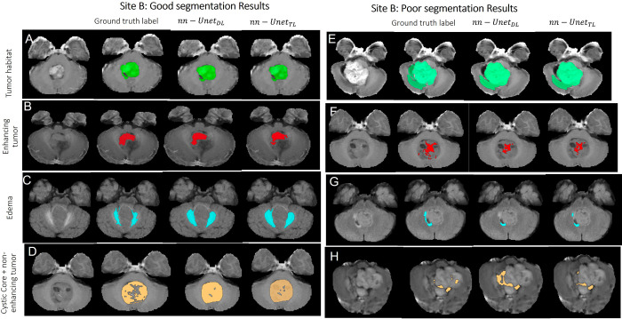 Representative examples of (A–D) good and (E–H) poor segmentation results obtained on patients from site B using both segmentation models. Each row shows, from left to right, the original MRI scan, the reference standard label for the subcompartment of interest, segmentation result from the nnU-NetDL model, and segmentation result from nnU-NetTL. Tumor habitat example segmentation results are shown in A (prediction accuracies of 0.85 for nnU-NetDL and 0.86 for nnU-NetTL) and E (accuracies of 0.8 for nnU-NetDL and 0.8 for nnU-NetTL). Enhancing tumor example segmentation results are shown in B (prediction accuracies of 0.897 for nnU-NetDL and 0.899 for nnU-NetTL) and F (accuracies of 0.38 for nnU-NetDL and 0.4 for nnU-NetTL). Edema example segmentation results are shown in C (prediction accuracies of 0.772 for nnU-NetDL and 0.773 for nnU-NetTL) and G (accuracies of 0.46 for nnU-NetDL and 0.52 for nnU-NetTL). Finally, nonenhancing tumor plus cystic core example segmentation results are shown in D (prediction accuracies of 0.8 for nnU-NetDL and 0.81 for nnU-NetTL) and H (accuracies of 0.28 for nnU-NetDL and 0.33 for nnU-NetTL). nnU-NetDL = direct learning nnU-Net model, nnU-NetTL = transfer learning deep learning model.