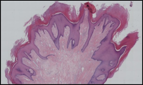 Giant acquired acral fibrokeratoma: A case report - PMC