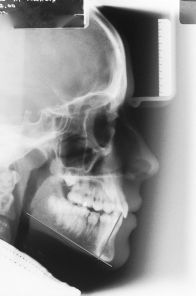 Figure 1. Downs’ method of measuring mandibular incisor inclination.