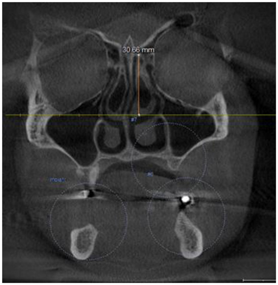 Assessing Olfactory Fossa Depth and Its Relationship with the ...