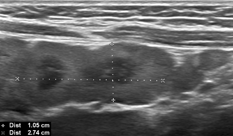 Image demonstrating confluent lymph nodes with a supra-centimetric small axis