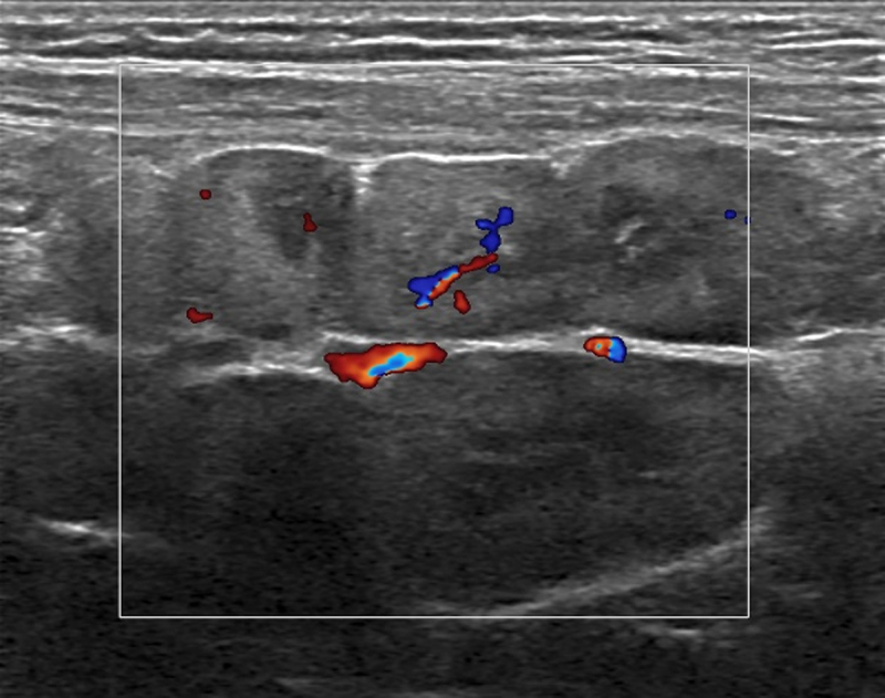 Image demonstrating hilar vascularisation of the lymph nodes