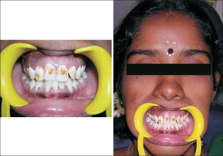 Fluorosis varied treatment options - PMC