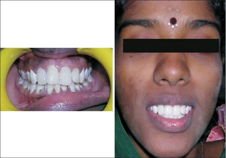 Fluorosis varied treatment options - PMC