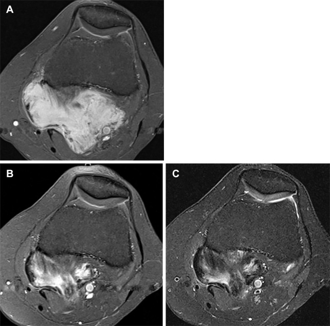 (A) Axial contrast-enhanced T1-weighted fat-suppressed MR image at baseline shows avidly enhancing desmoid fibromatosis deep in the popliteal fossa, maximum diameter measured 66 mm. (B) After 10 months’ systemic therapy, there was significant reduction in enhancement throughout the tumor, reflecting increased collagenization; maximum diameter measured 55 mm. By RECIST 1.1, this 17% reduction in tumor diameter would be considered stable disease, highlighting RECIST 1.1 insensitivity to biologic tumor response. In contradistinction, the contrast-enhancement ratio decreased by approximately 50%, indicating partial response by MRI-modified Choi criteria. (C) Axial fat-suppressed proton density–weighted MR image (repetition time msec/echo time msec, 2980/50) also from the 10-month time point mirrors the pattern of contrast enhancement observed in B, highlighting that these sequences similarly map the tumor’s cellular and collagenous elements. mrChoi = modified MRI-based Choi, RECIST = Response Evaluation Criteria in Solid Tumors 1.1.