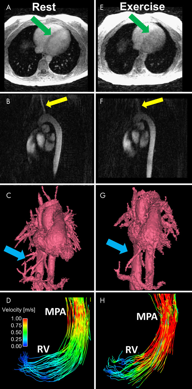 A–D, Representative images obtained at rest include an A, axial magnitude image, B, sagittal PC angiogram, C, segmented volume-rendered PC angiogram reconstructed from a 4D flow MRI acquisition, and D, pathline visualization image in the RV and MPA. Images E–H show corresponding images obtained during exercise. Increased blurring and decreased conspicuity of regions with slow or complex flow are observed in the axial magnitude image (E, green arrows) and sagittal PC angiogram (F, yellow arrows). G, The volume-rendered angiogram obtained during exercise shows loss of fine vessel detail (blue arrows). H, The pathline visualization image shows increased velocities in the RV and MPA at peak systole. MPA = main pulmonary artery, PC = phase-contrast, RV = right ventricle.