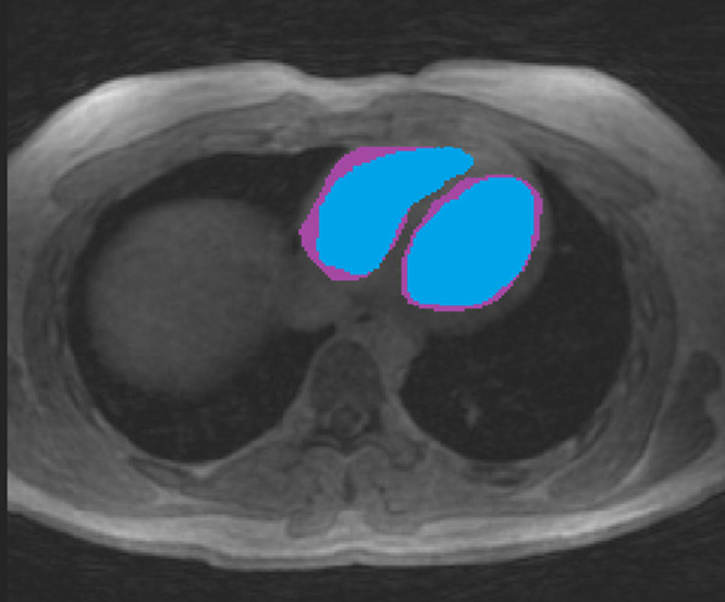 Comparison of segmented masks in the RV and LV between two observers. One observer (blue mask) was consistently more conservative in segmentation than the other observer (purple mask) owing to the poor contrast between the blood pool and myocardial wall. LV = left ventricle, RV = right ventricle.