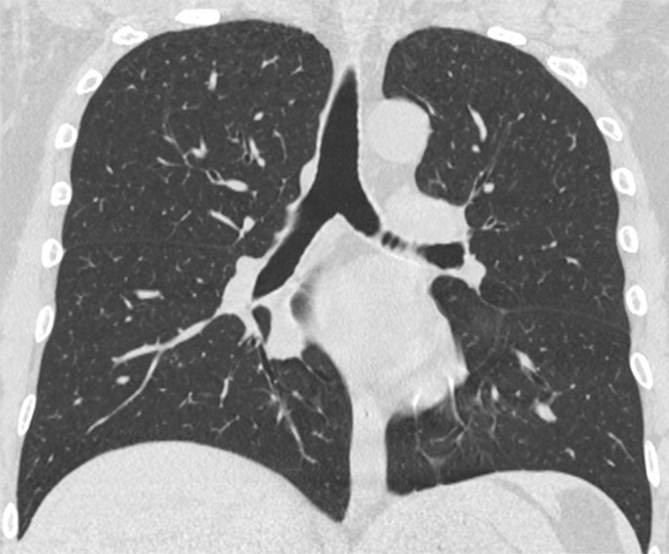 A 47-year-old man arriving at the emergency department with fever and diarrhea. (a) The baseline CT scan did not show findings suggestive for a pneumonia-“negative” pattern, but the real-time polymerase chain reaction test was positive for severe acute respiratory syndrome coronavirus 2 infection. (b) After 5 days, owing to a worsening of the clinical conditions, CT was repeated, revealing a “typical” pattern characterized by bilateral ground-glass opacities (circle). (c) After 12 days (17 days from the onset of symptoms), further radiologic progression with development of diffuse alveolar damage and acute respiratory distress syndrome would lead to the death of the patient.