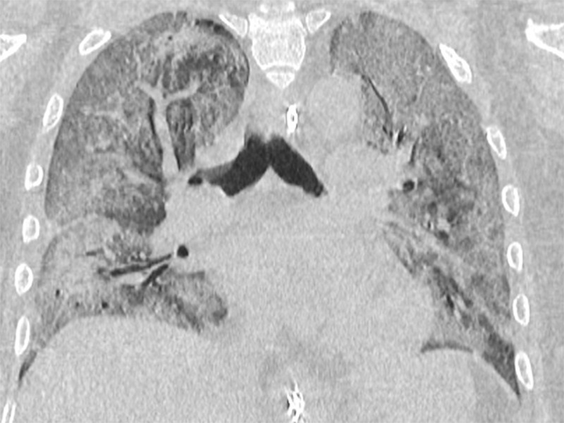 A 47-year-old man arriving at the emergency department with fever and diarrhea. (a) The baseline CT scan did not show findings suggestive for a pneumonia-“negative” pattern, but the real-time polymerase chain reaction test was positive for severe acute respiratory syndrome coronavirus 2 infection. (b) After 5 days, owing to a worsening of the clinical conditions, CT was repeated, revealing a “typical” pattern characterized by bilateral ground-glass opacities (circle). (c) After 12 days (17 days from the onset of symptoms), further radiologic progression with development of diffuse alveolar damage and acute respiratory distress syndrome would lead to the death of the patient.