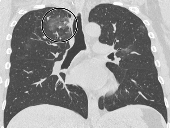 A 47-year-old man arriving at the emergency department with fever and diarrhea. (a) The baseline CT scan did not show findings suggestive for a pneumonia-“negative” pattern, but the real-time polymerase chain reaction test was positive for severe acute respiratory syndrome coronavirus 2 infection. (b) After 5 days, owing to a worsening of the clinical conditions, CT was repeated, revealing a “typical” pattern characterized by bilateral ground-glass opacities (circle). (c) After 12 days (17 days from the onset of symptoms), further radiologic progression with development of diffuse alveolar damage and acute respiratory distress syndrome would lead to the death of the patient.