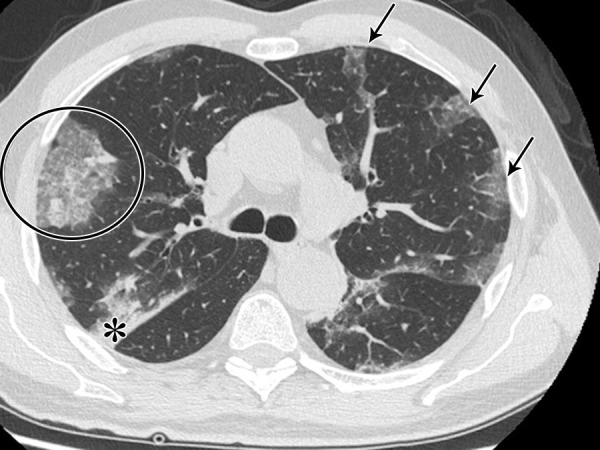 The “typical” pattern in a 62-year-old man with COVID-19, characterized by bilateral ground-glass opacities peripheral in distribution (arrows), consolidations (*), and crazy paving (circle).