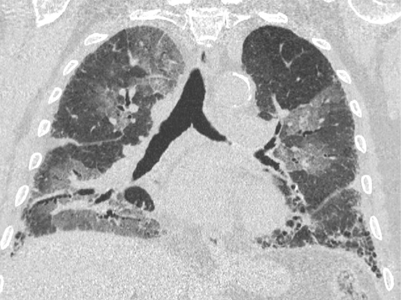 An 89-year-old man with a known interstitial lung disease, arriving at the emergency department with dyspnea. (a) The CT scan documented a diffuse ground-glass opacity, without a specific distribution, an “indeterminate” pattern. The real-time reverse-transcription polymerase chain reaction test was positive for severe acute respiratory syndrome coronavirus 2. In addition, in this case, (b) dilatation of pulmonary vessels was seen (arrow).