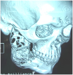 Fig 3:CT SCAN also showing multilocular images in mandible