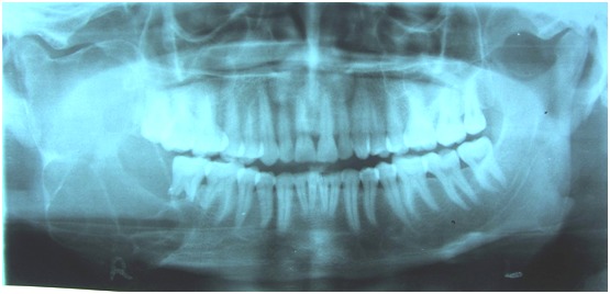 Fig. 2:OPG showing multilocular radiolucency