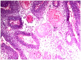 Fig 4: Histopathological picture showing acanthomatous changes