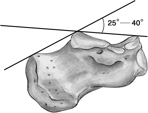 Bohler’s angle’s role in assessing the injury severity and functional ...