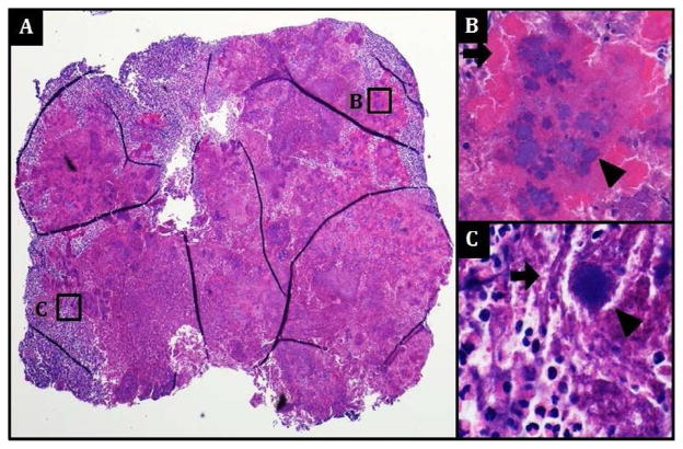 Adenoid Stones – “Adenoliths” - PMC