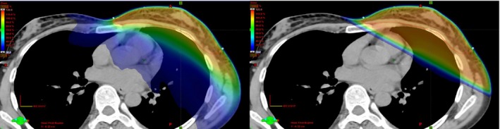 Dosimetric Comparison Of Vmat With Integrated Skin Flash To 3d Field‐in 