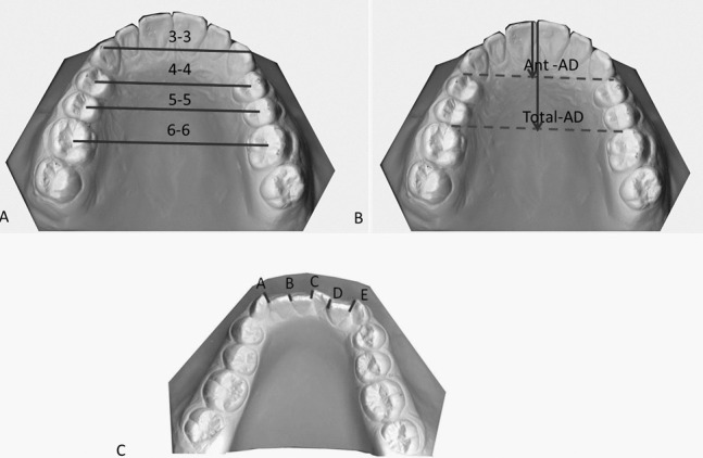 Figure 1. Dental arch measurements. (A) Arch width measurements. (B) Arch depth measurements. (C) Incisor irregularity = A + B + C + D + E.11