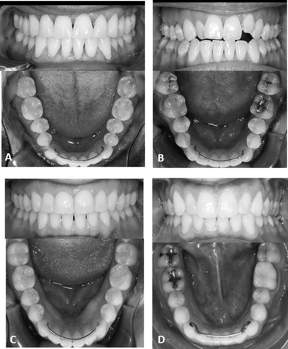 Figure 6. The four patients with long-term mandibular fixed retainers. (A), 41-year-old male patient, 26.3 years posttreatment; (B), 38-year-old female, 23 years posttreatment; (C), 36-year-old female, 22 years posttreatment; (D), 37-year-old male, 21 years posttreatment.