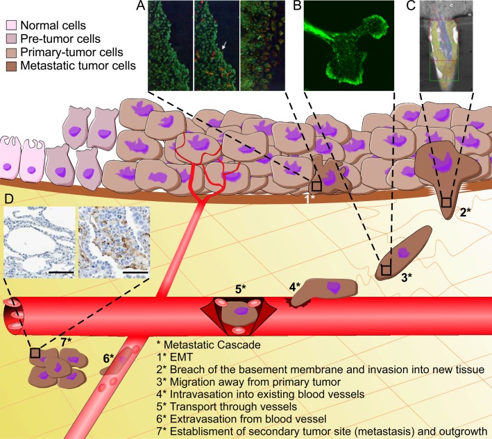 The Role of Vimentin Intermediate Filaments in the Progression of Lung ...