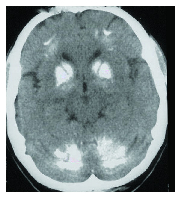 Fahr's Disease Presenting With Dementia At Onset: A Case Report And 