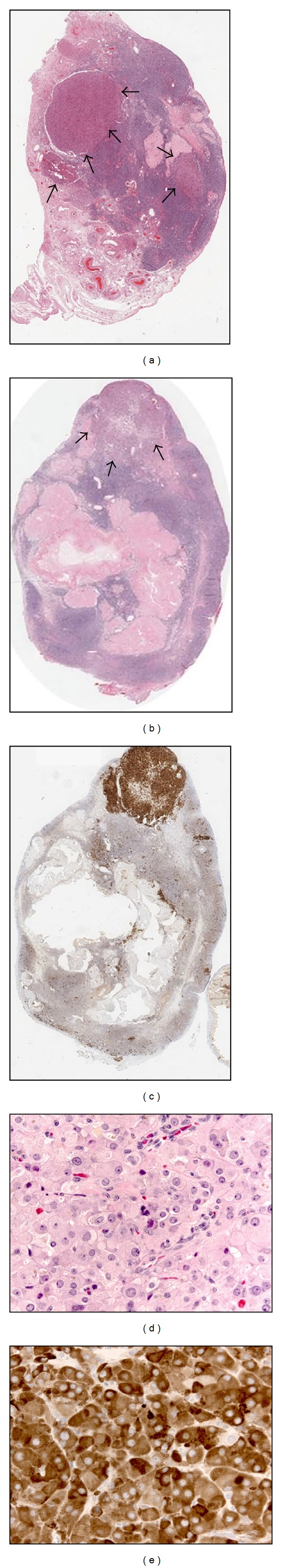 Ovarian Leydig Cell Hyperplasia: An Unusual Case of Virilization in a ...