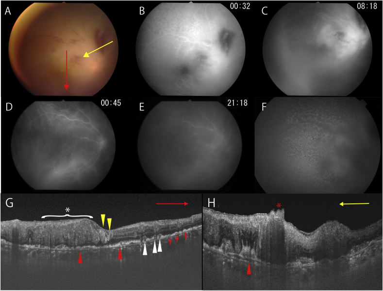 Multimodal imaging of secondary vitreoretinal lymphoma with optic ...