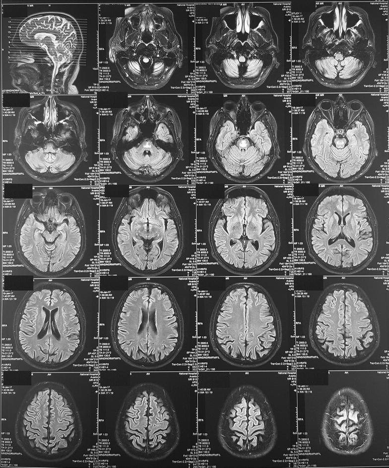 Tongue fasciculations with denervation pattern in osmotic demyelination ...