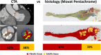 Example images show comparison of tissue quantification of the aortic
valve from CT angiography (CTA) and histologic assessment with use of Movat
pentachrome staining in a 75-year-old male participant with aortic stenosis.
For CTA, a region of interest was defined between the lower coronary ostium
and the virtual basal ring using coronal and axial planes; scan-specific
thresholds were used for fibrotic (red) and calcific (yellow) tissues. For
quantitative histologic assessment, every valve was evaluated using nine
nonconsecutive slices (three per cusp), and the proportion of fibrotic (red)
and calcific (yellow) tissues was averaged across the whole set. The bottom
right CTA image is not supported by artificial intelligence.