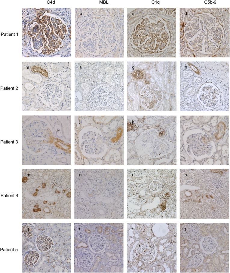 Complement Factor C4d Is a Common Denominator in Thrombotic ...