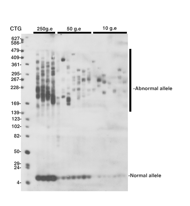 Detection of CTG repeat instability in blood from a 27 year-old DM1 patient carrying more than 170 CTG repeat