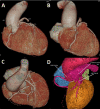 3D CTA of coronary artery fistula arising from LAD and joined with second fistula arising from RCA