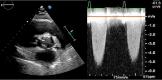 Short axis view echo of bicuspid valve with increased velocity; see also at https://youtu.be/4C2kncWIOqM
