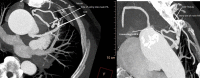 CTA axial view showing course of fistula