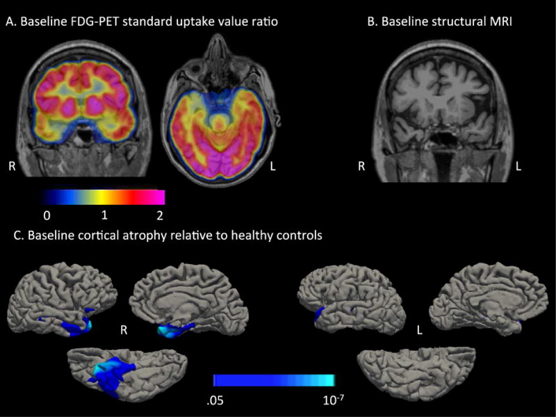 Geschwind Syndrome in Frontotemporal Lobar Degeneration ...