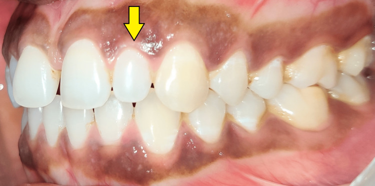 A Multidisciplinary Aesthetic Treatment Approach for Peg Lateral of the ...