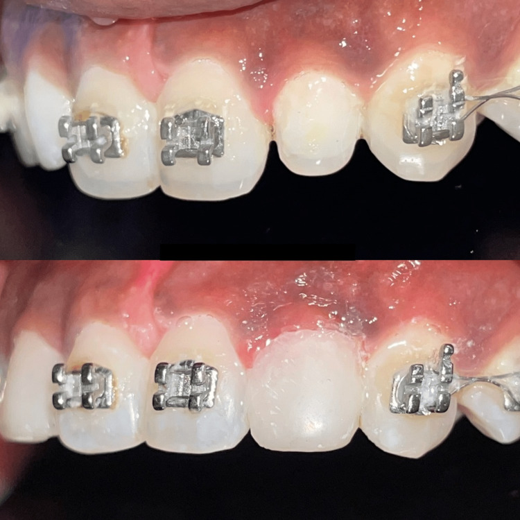 A Multidisciplinary Aesthetic Treatment Approach for Peg Lateral of the ...