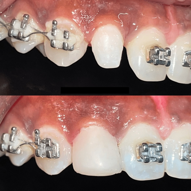 A Multidisciplinary Aesthetic Treatment Approach for Peg Lateral of the ...