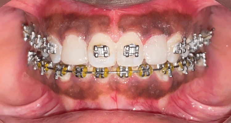 A Multidisciplinary Aesthetic Treatment Approach for Peg Lateral of the ...