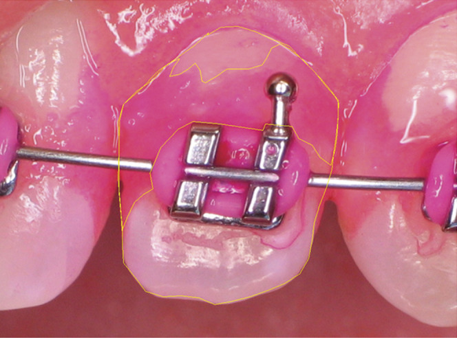 Figure 1. Photograph of disclosed tooth image showing the outline of areas analyzed using the Digimizer software program.